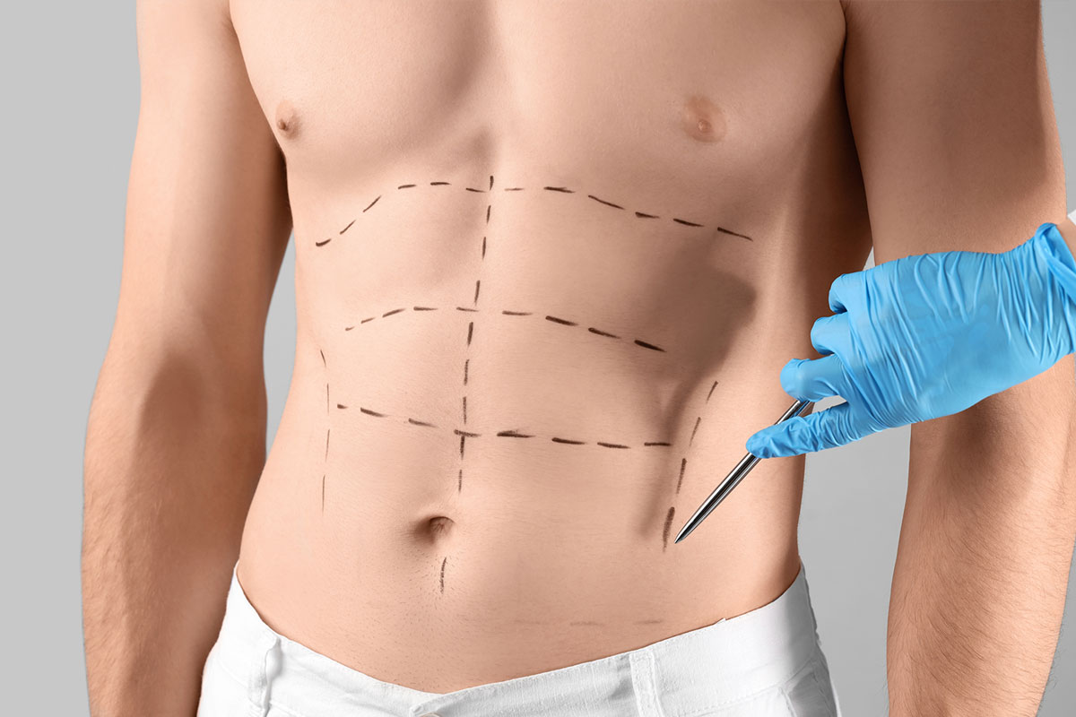 Liposucción para hombres