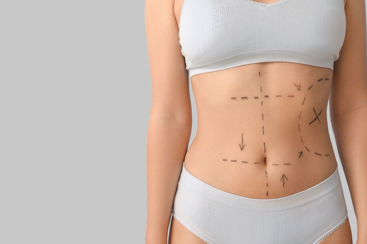 Liposucción para mujeres